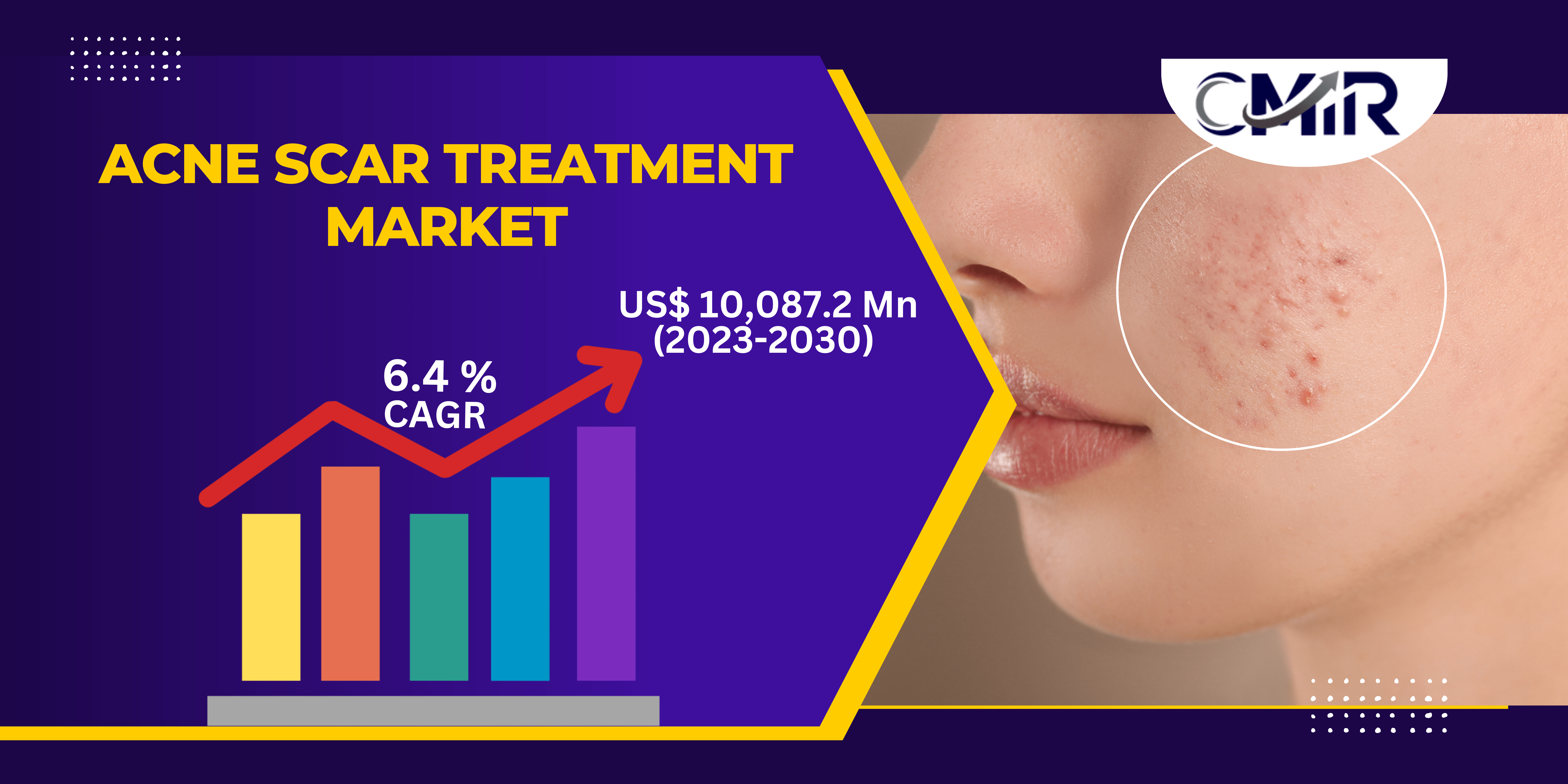 Acne Scar Treatment Market